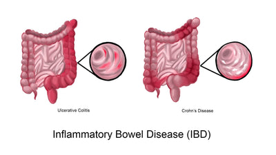 IRRITABLE BOWEL DISEASE (IBD)